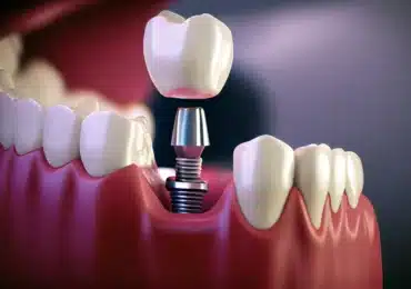 dental-implant