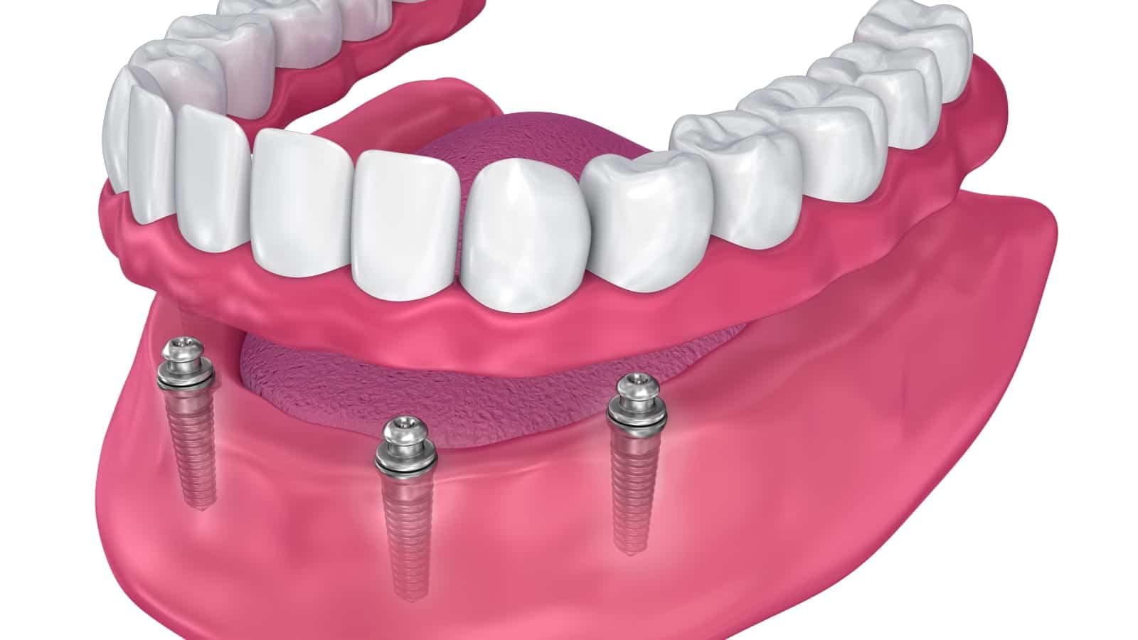Hareketli Protezler için Ball Attachment Avantajları
